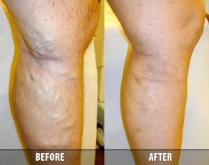 What to Consider Before Deciding on Varicose Vein Treatment