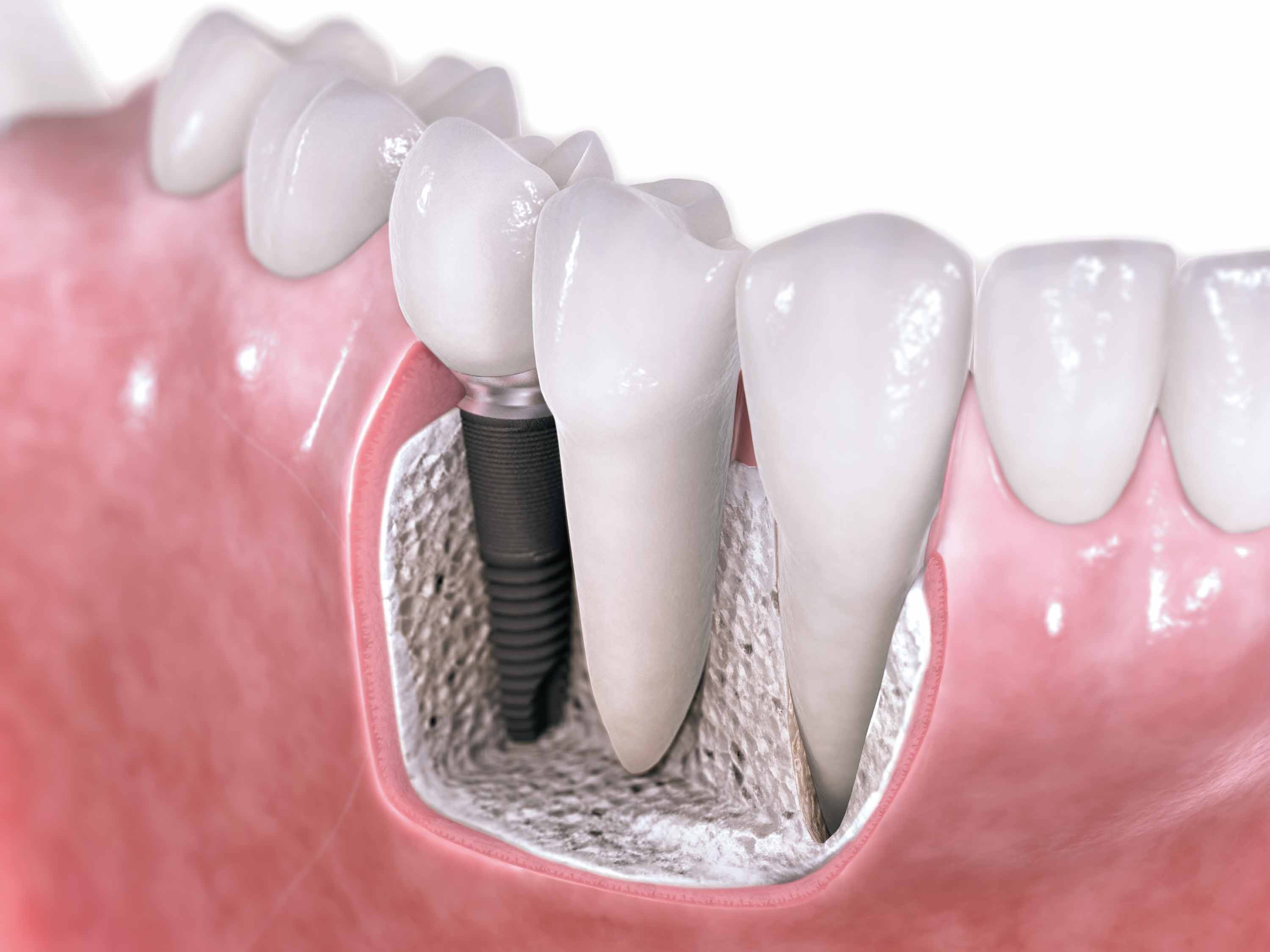 Dental Implants in Miami Lakes: The Comprehensive Guide to Restoring Your Smile