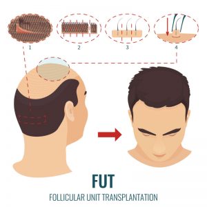 A Hair Transplant in CT for an Increasingly Common Genetic Problem