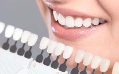 The Benefits of Teeth Whitening in New Lenox